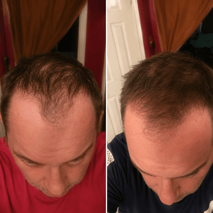 DENSIQ Pro - Instant Hair Density Filler